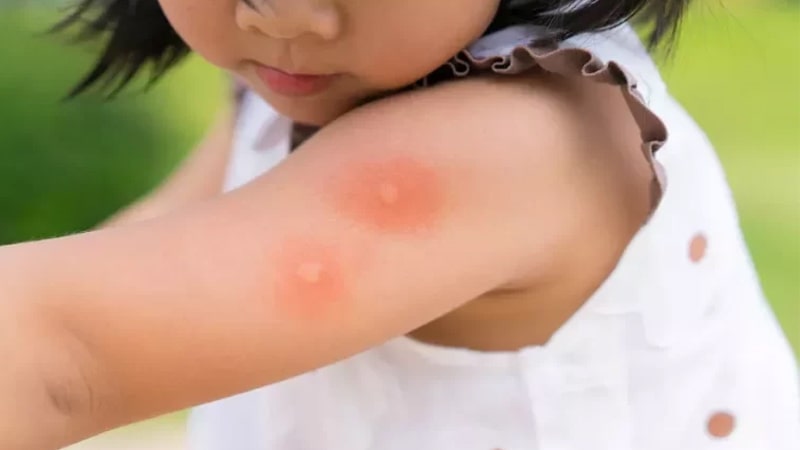 آلرژی به حشرات