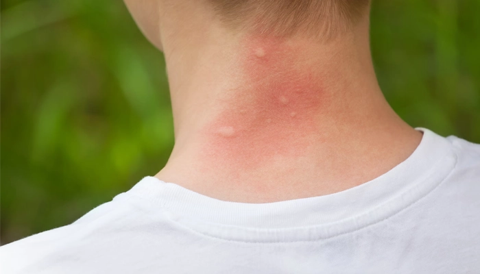 تصویر نیش پشه