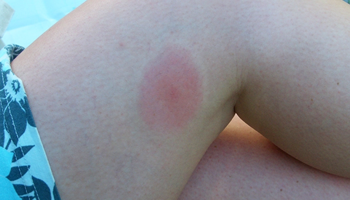 عکس نیش پشه