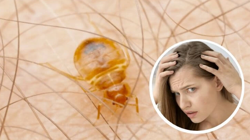 آیا ساس در موی سر زندگی می کند؟ 