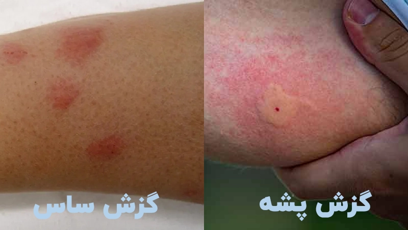 تفاوت بین نیش ساس و پشه