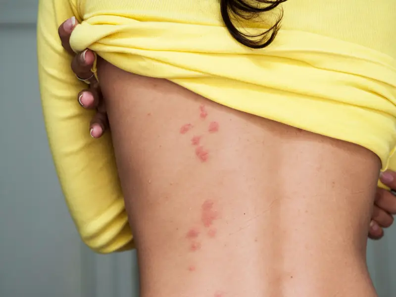 درمان گزیدگی حشرات