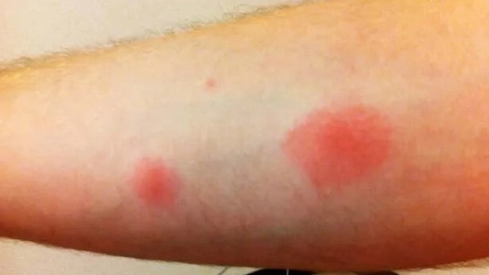 عکس جای گزش سوسک