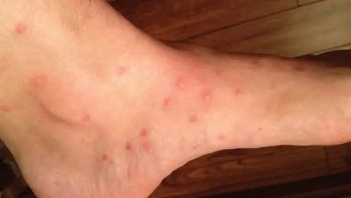 تصویر گزش کک