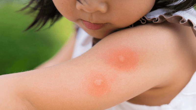 جای نیش حشرات