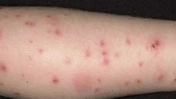 عکس جای گزش کک